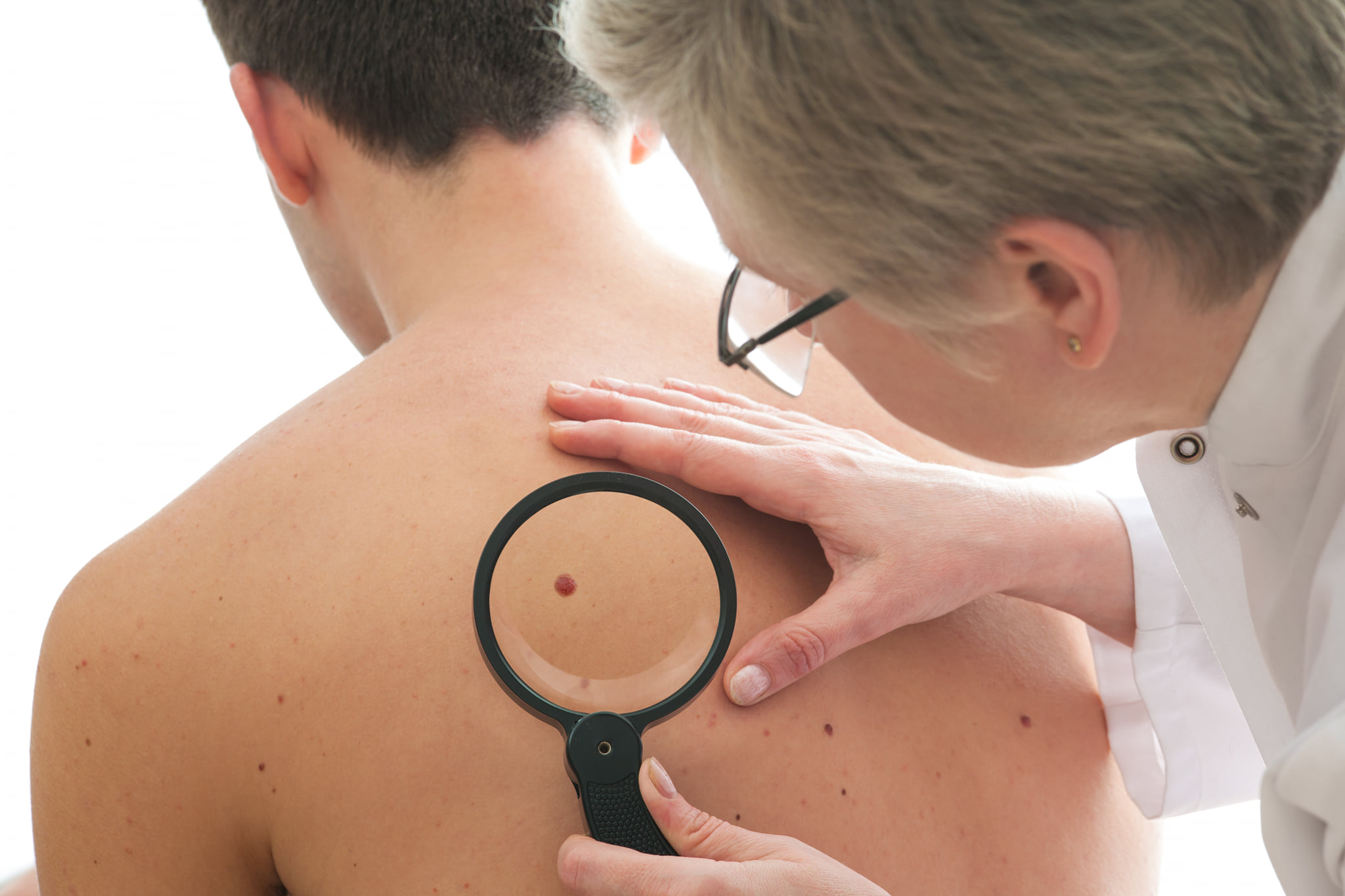 Number of Skin Cancer Cases Rising Rapidly